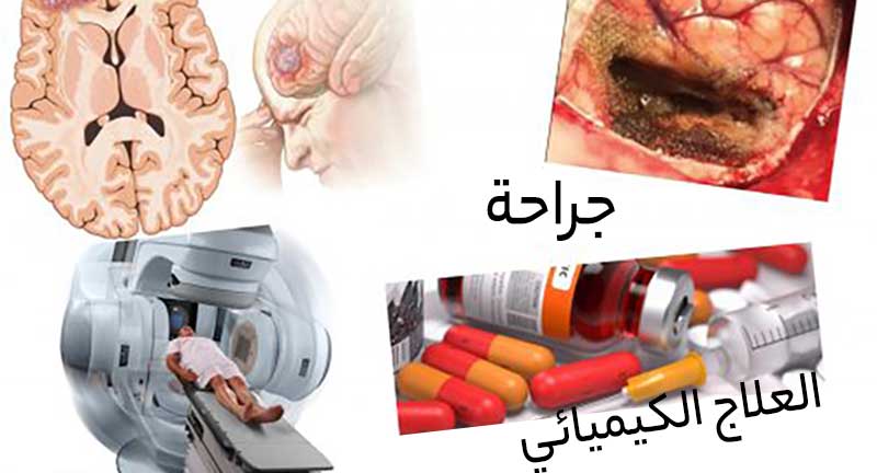 طرق علاج أورام المخ