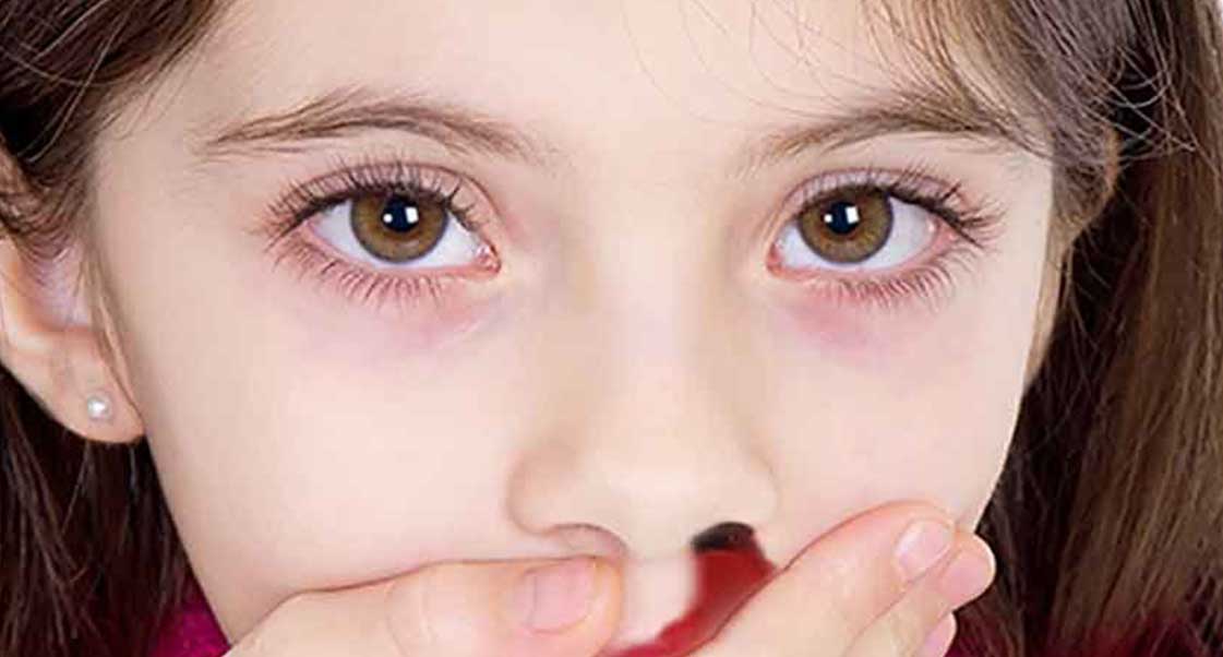علاج نزيف الأنف المفاجئ