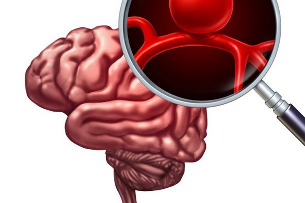 آشنایی با آنوریسم مغزی و علل پدیدآورنده ی آن