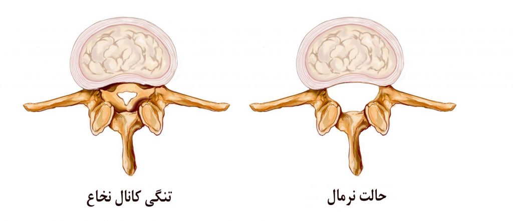 آیا تنگی کانال نخاع درمان قطعی دارد؟