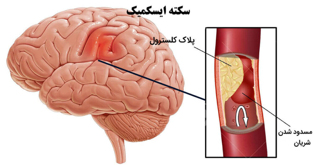 پارگی رگ مغز