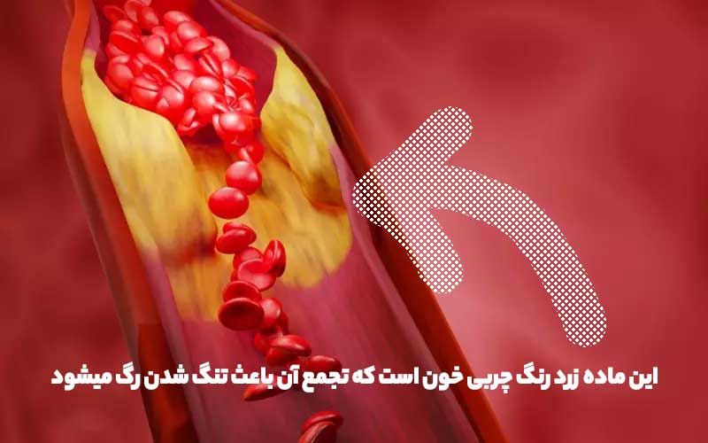 تجمع چربی در خون را نشان می دهد